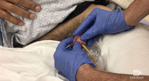 Paraphimosis Reduction