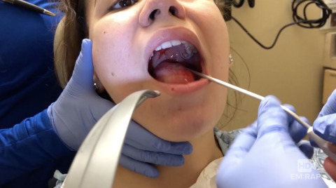 Peritonsillar Abscess Needle Aspiration and Incision and Drainage