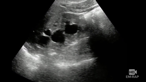 Ultrasound of Hydronephrosis