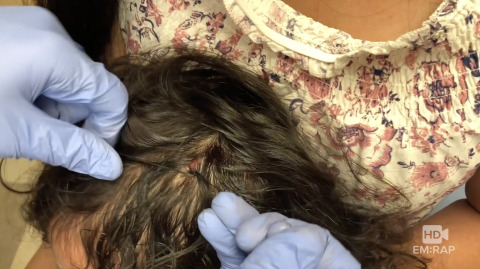 Hair Apposition Technique