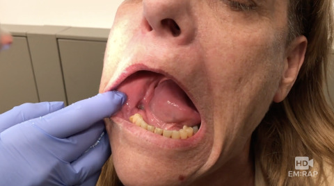 Reimplantation of Avulsed Tooth