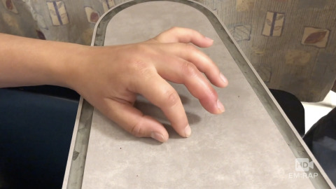 Flexor Tenosynovitis