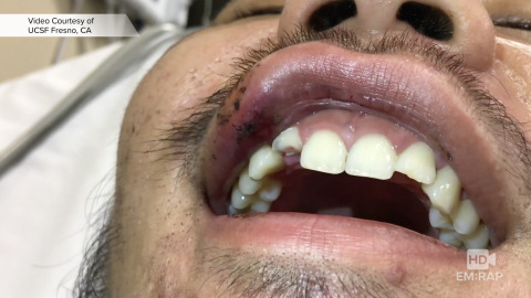 Calcium Hydroxide for Tooth Fracture