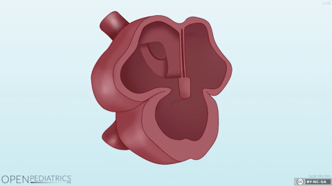 Atrial Septal Defect