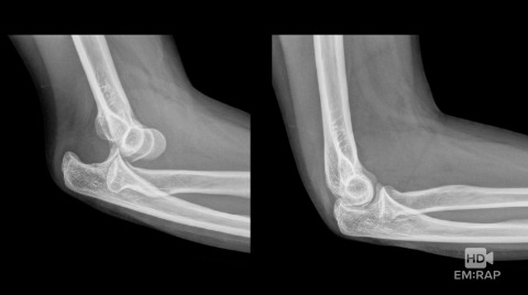 Reduction of Elbow Dislocation