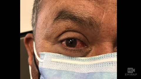 Eye Irrigation for Chemical Burn