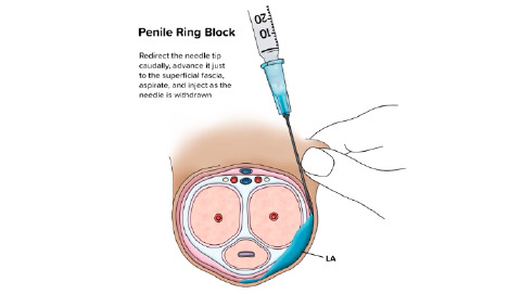 Dorsal Penile Nerve Block
