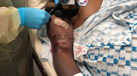 Suturing a Bleeding Dialysis Fistula