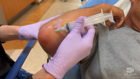 Aspiration of Olecranon Bursitis