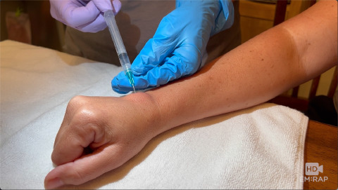 Ganglion Cyst Aspiration and Injection