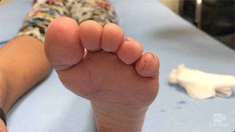 Skin Glue (Tissue Adhesive)