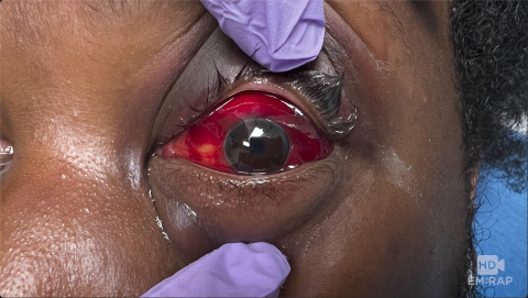 Inferior Rectus Entrapment from Orbital Floor Fracture
