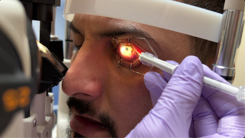 Removal of Metal Embedded in Cornea