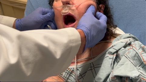 Jaw Reduction by Extra-oral Technique - Presented by Al Sacchetti