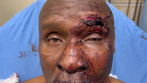 Ptosis Due to Eyebrow Laceration Through the Levator