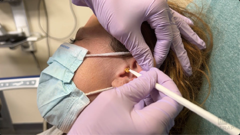 Manual Removal of Cerumen Impaction (Earwax)