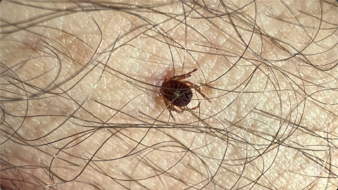 Tick Removal