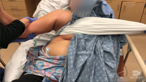 Shoulder Reduction by Traction Countertraction