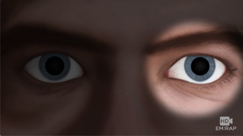 Afferent Pupillary Defect