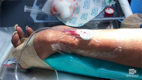 Radial Arterial Line with Guidewire and Ultrasound Guidance