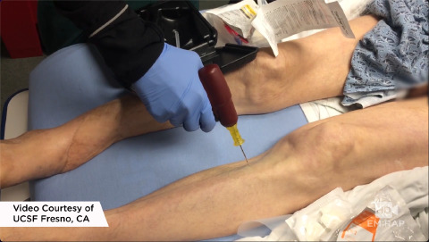 Intraosseous Access with EZ-IO