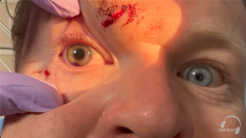 Hyphema and Traumatic Mydriasis