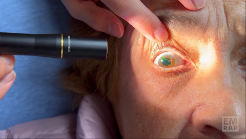 Lens Dislocation with Phacodonesis