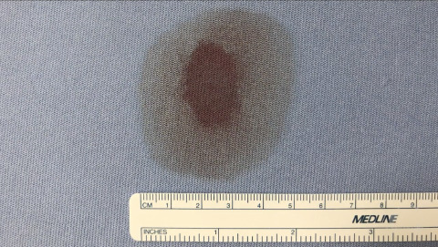 Halo Sign from Basilar Skull Fracture