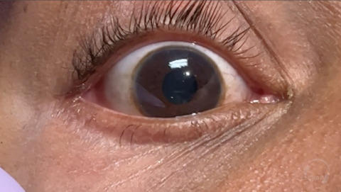Kayser-Fleischer Ring Around the Iris in Wilson Disease