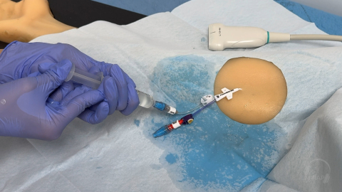 Placement of a Midline Catheter (PICC)
