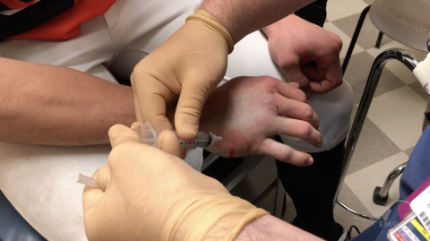 Hematoma Block of Metacarpal Fracture