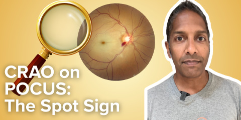 Daily Dose 2026 February 13: CRAO on POCUS: The Spot Sign