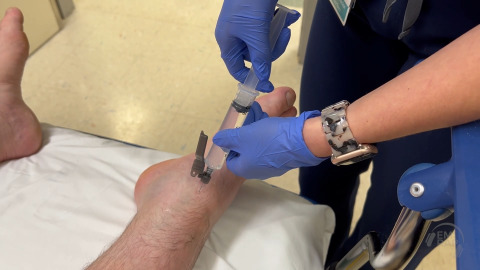 Hematoma Block of Ankle Fracture