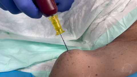 Humeral Intraosseous Line