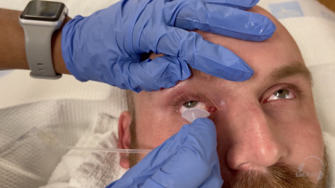 How to Insert Morgan Lenses