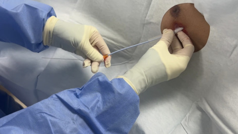 Chest Tube