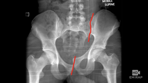 Pelvic Fractures
