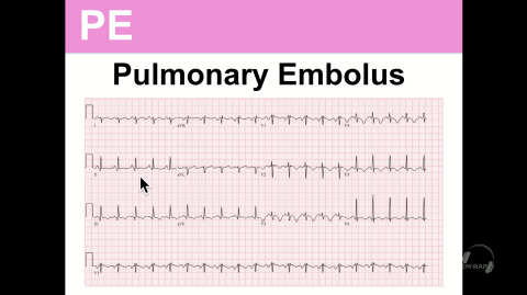 EM:RAP Live: March 2017 > ECG Course: Chest Pain