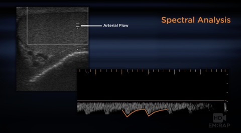 Ultrasound of Testicular Torsion