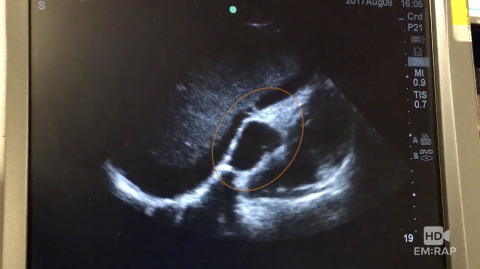 Saline Flush to Confirm Central Line Placement