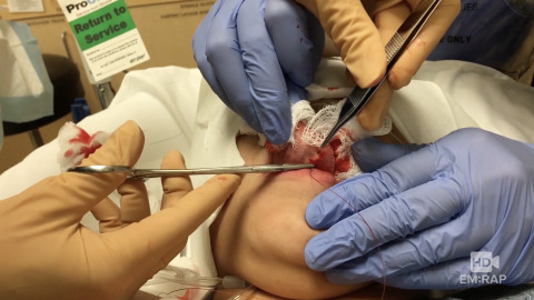 Tongue Laceration Repair with Sutures